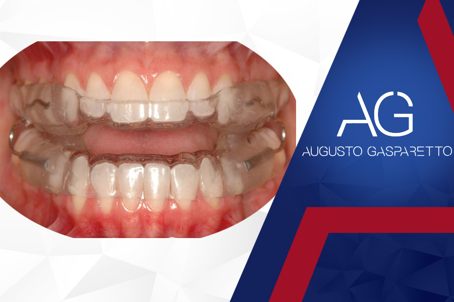 Aparelho Intra-Bucal