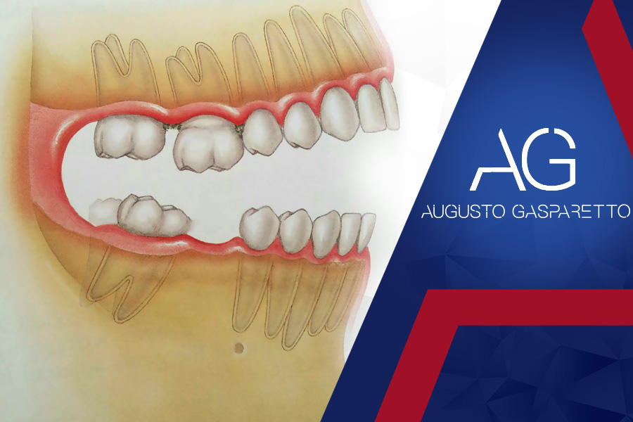 Consequências da perda de 1 dente
