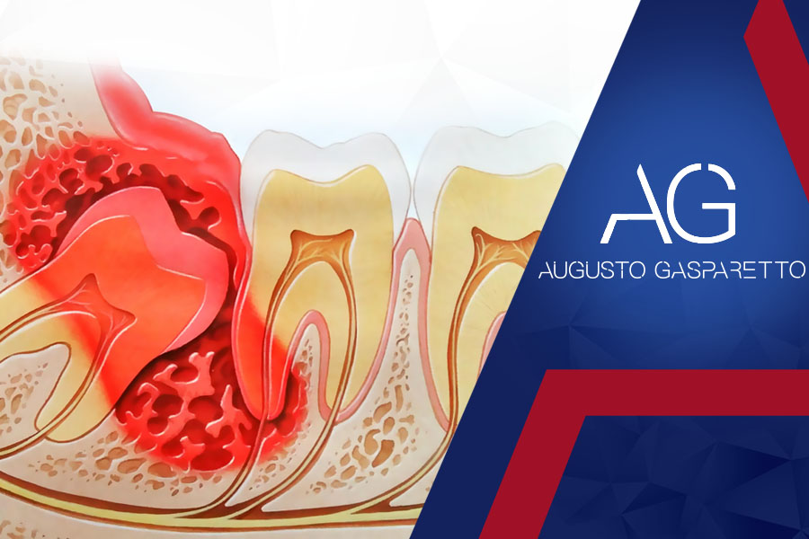 Dor Aguda - Inflamacao